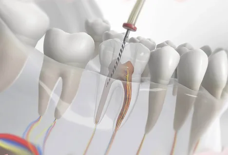 Instrumentation and irrigation in endodontics