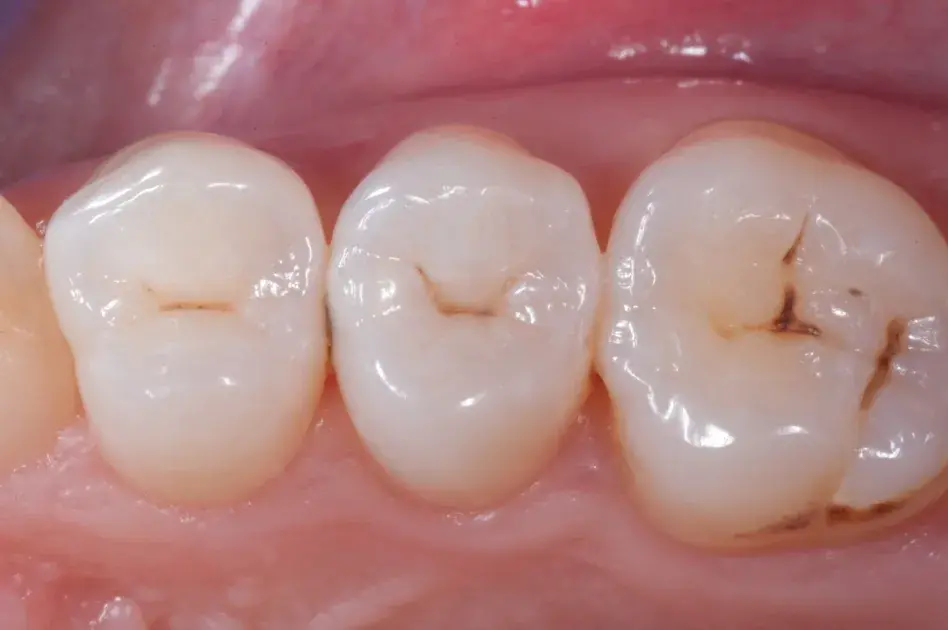 Девитальный зуб 1.5. Окклюзионная поверхность.
