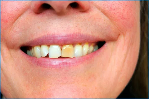 Тактика врача при необходимости коррекции цвета зуба