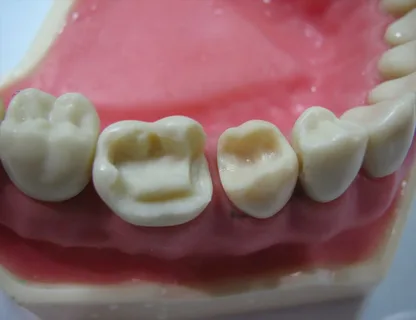 Принципы препарирования жевательных зубов