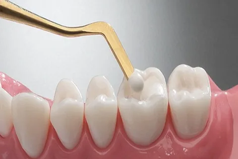 Stages of cavity restoration and composite polymerization