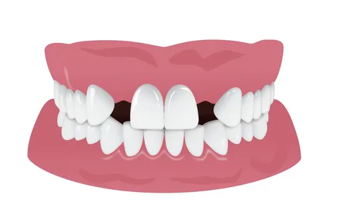 Zustand der Mundhöhle mit teilweisem Zahnverlust