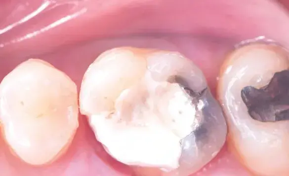 Caries of molar