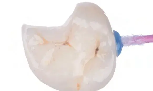 Indirect tooth restoration