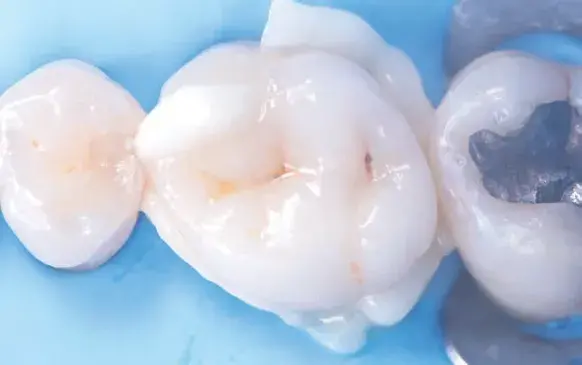 Tooth restoration cementation