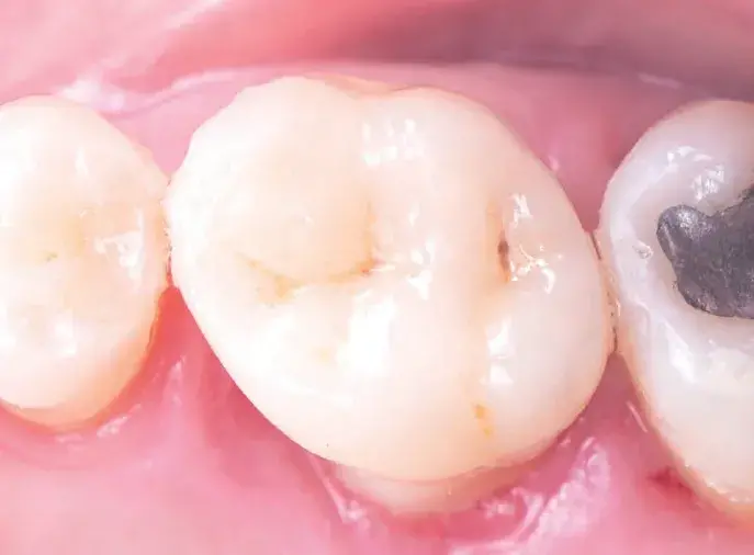 Indirect tooth restoration