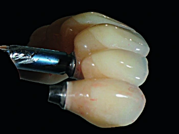 Implant-based prosthesis