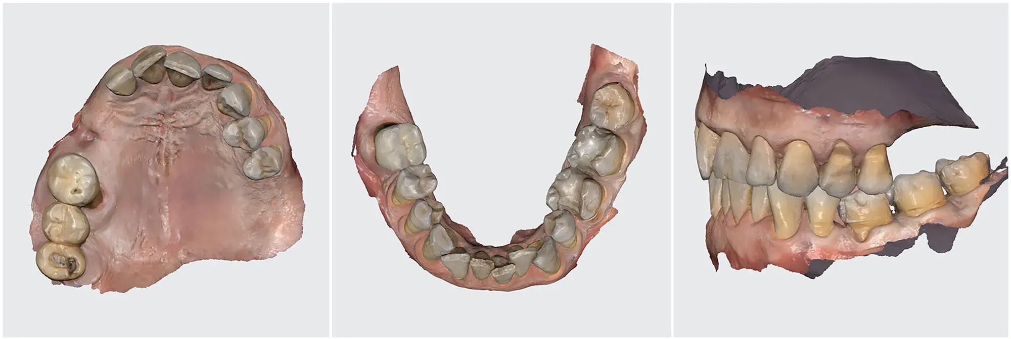 Intraoral scanning