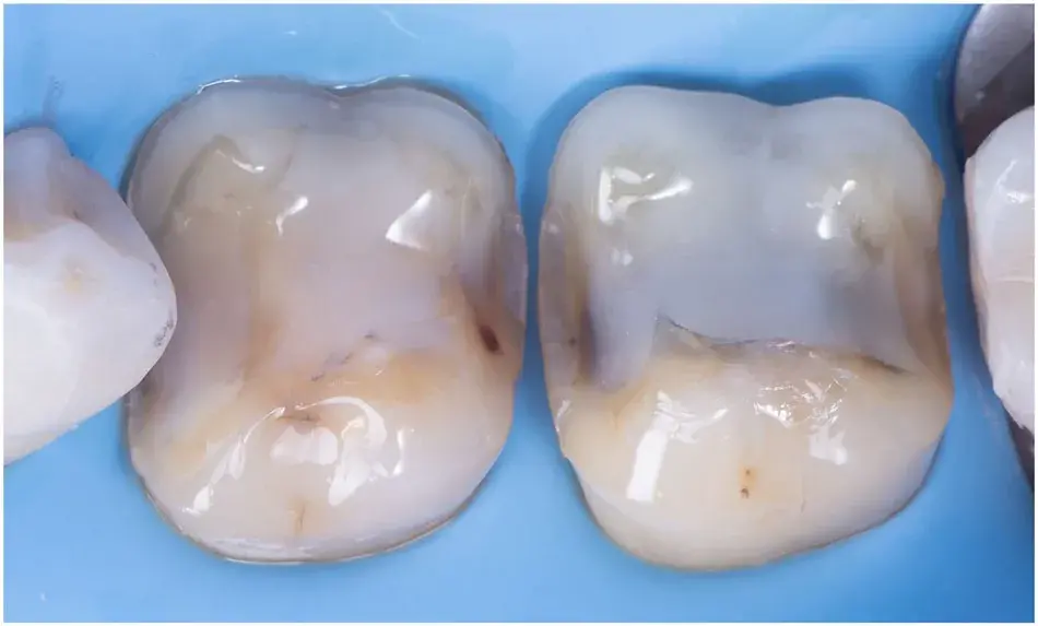 Tooth preparation under dental dam isolation