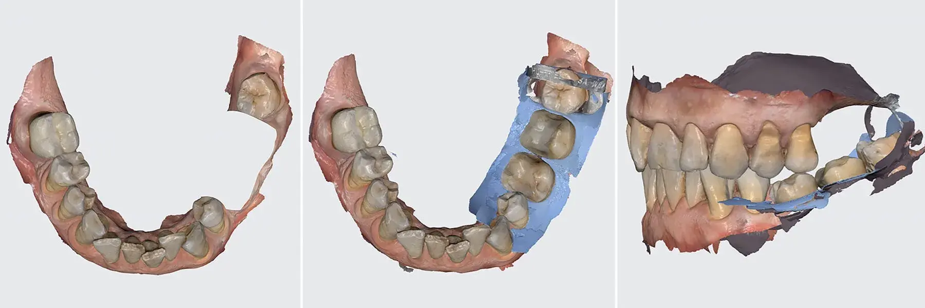 Intraoral scanning