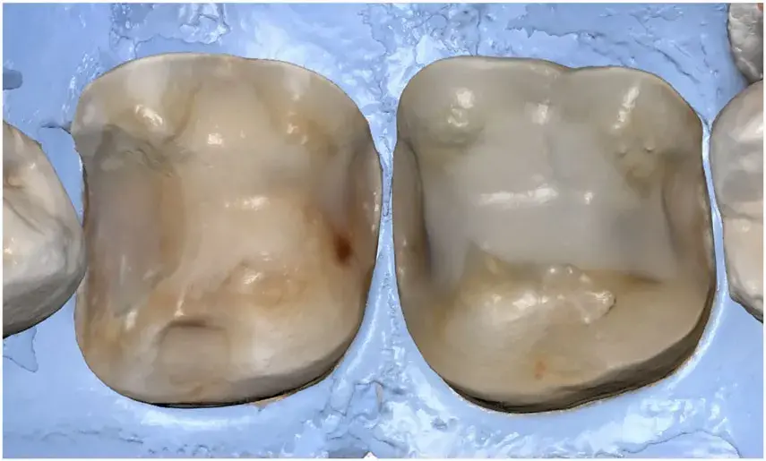 Intraoral scanning under dental dam isolation