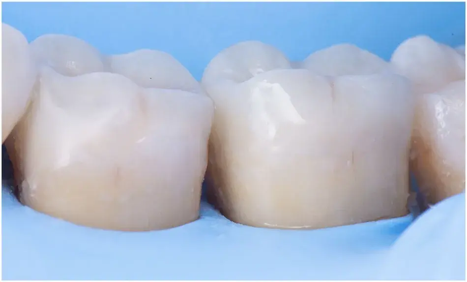 Ceramic restoration cementation under dental dam isolation