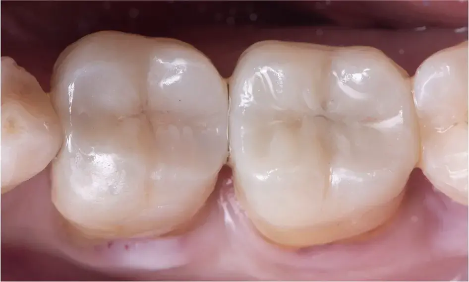 Ceramic tooth restoration