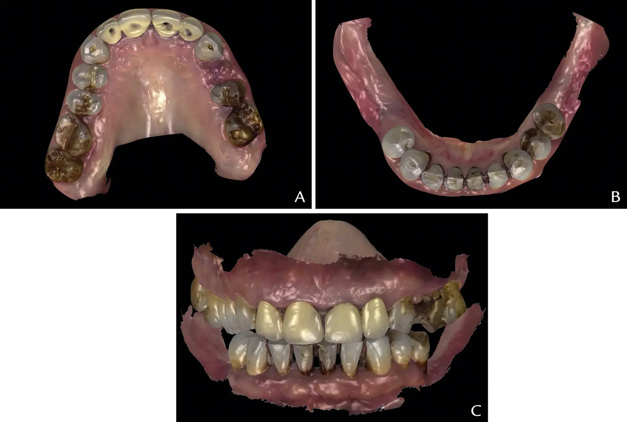 Intraoral scans STL view