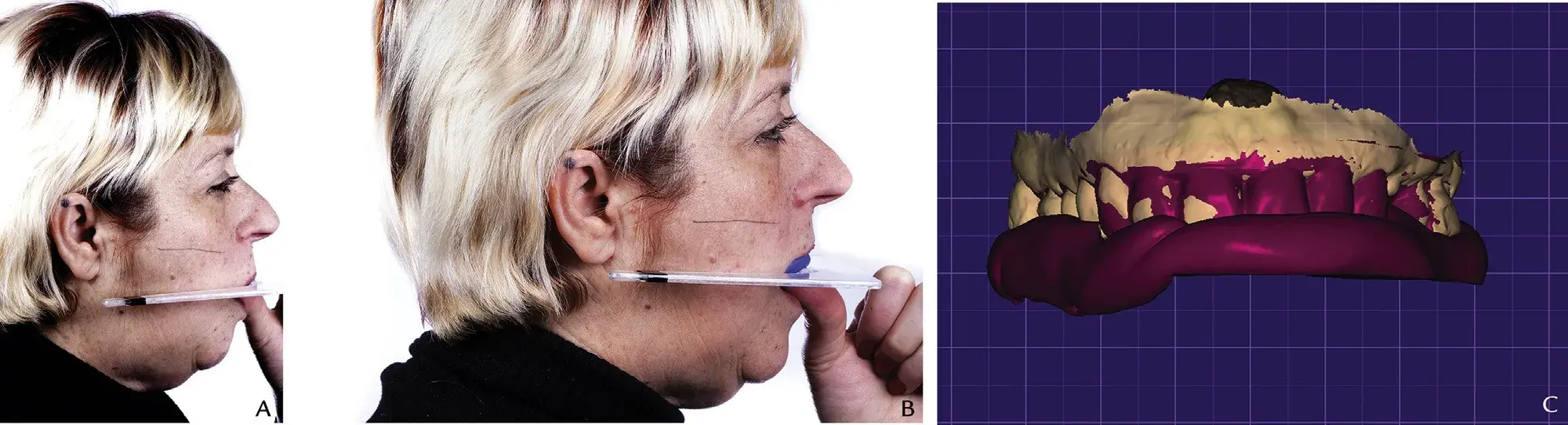 Occlusal plane recording