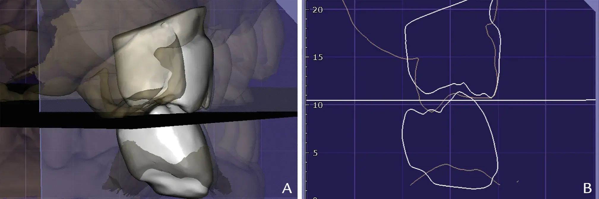 Generation of occlusal plane