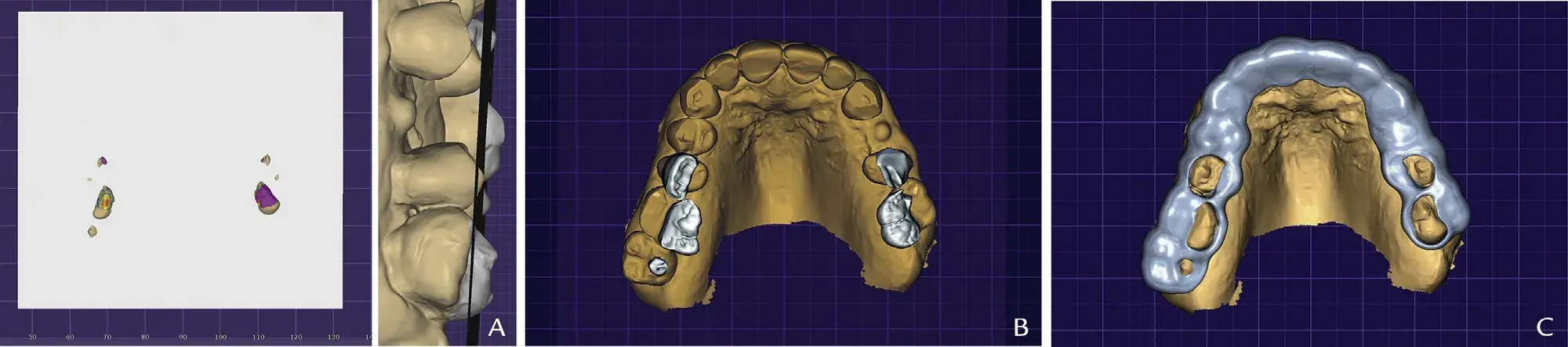 CAD CAM protocol