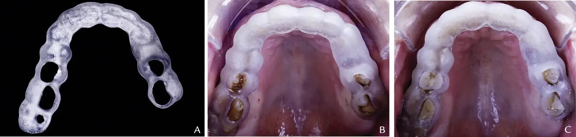 3D printed occlusal guide