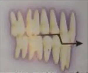 Deckbiss occlusal plane