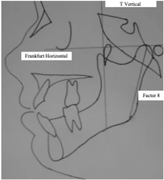 Simplified Bimler Cephalometry