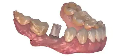 Escaneado intraoral