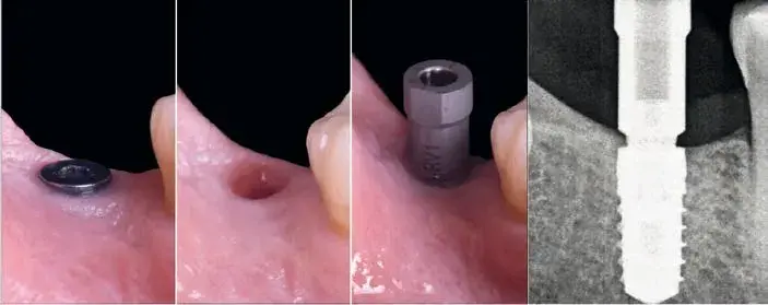 Protocolo de escaneado intraoral para impresión digital