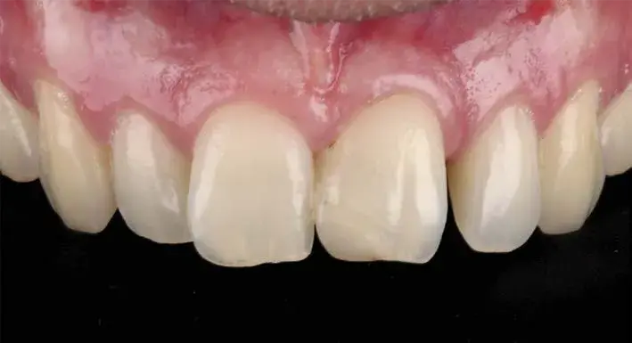 Aesthetic tooth defect