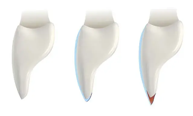 Restorative protocol for additive veneer