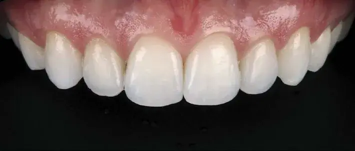 Discolored teeth