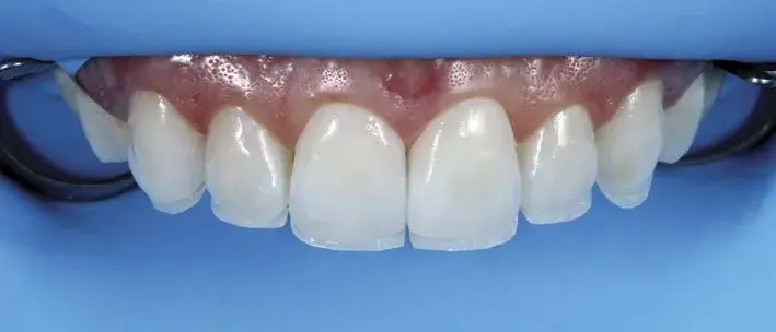 Palatal enamel