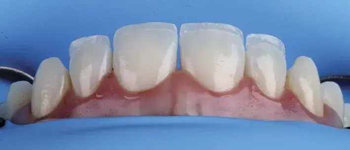 Palatal enamel