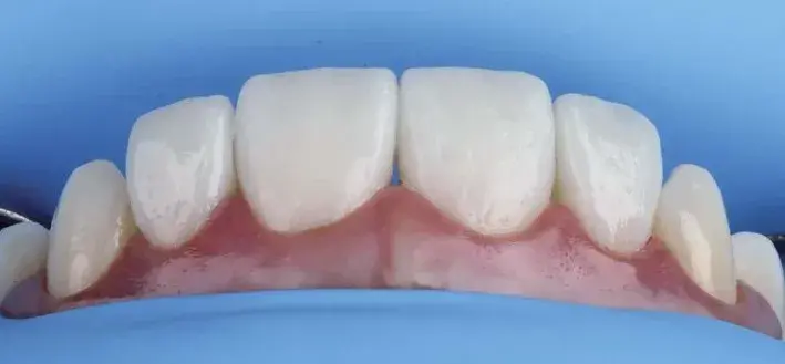 Labial enamel