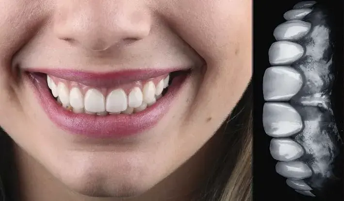 Direct veneers