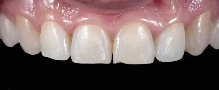 incisal edge wear of the central incisors and canine tips