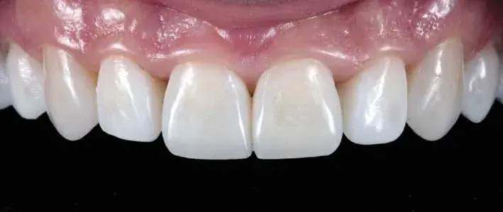 Direct composite veneers