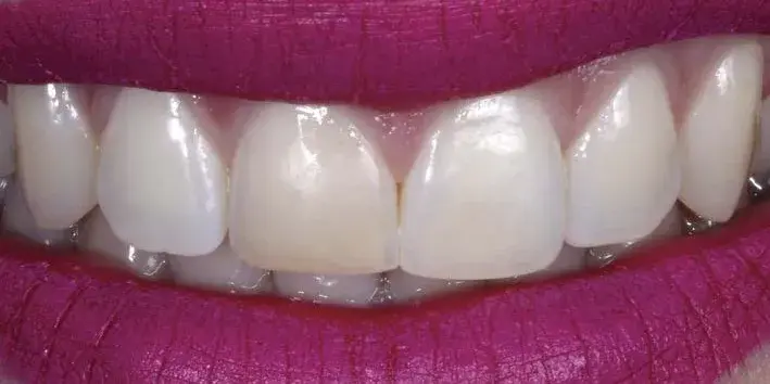 Tooth discoloration