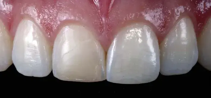 Discolored restoration