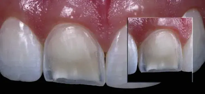 Resin removal and conservative veneer preparation 