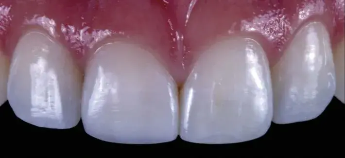 Direct composite veneers