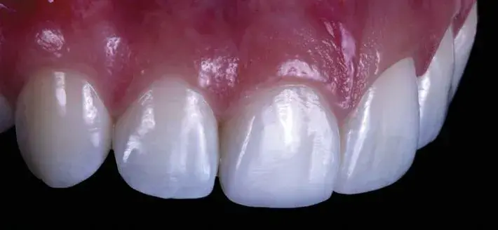 Direct composite veneers