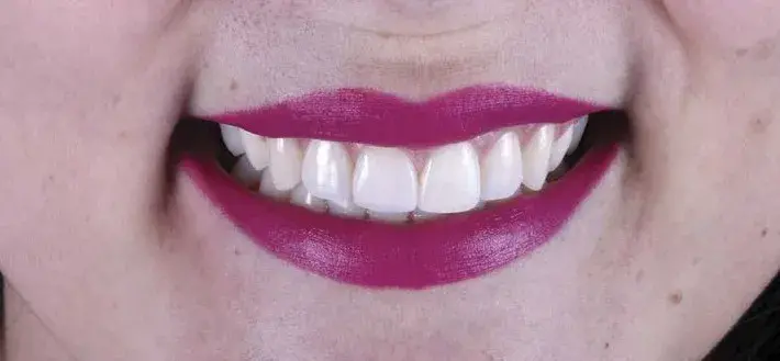 Direct composite veneers