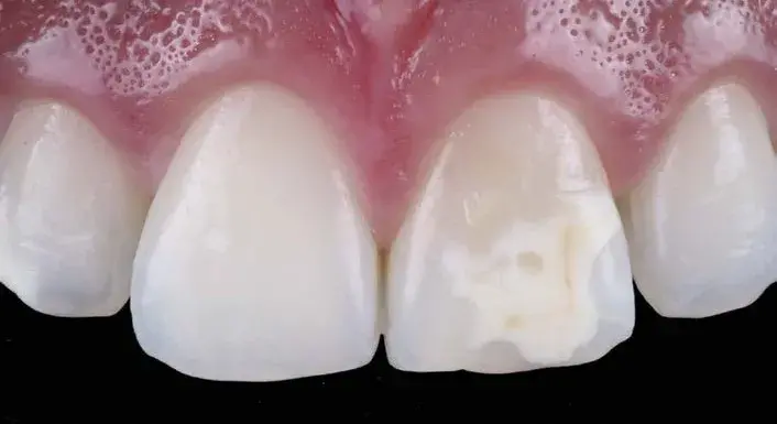 Tooth pigmentation