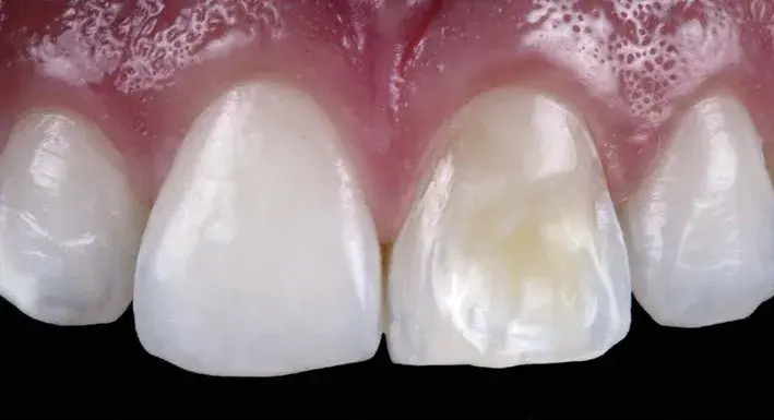 Superficial Veneer preparation