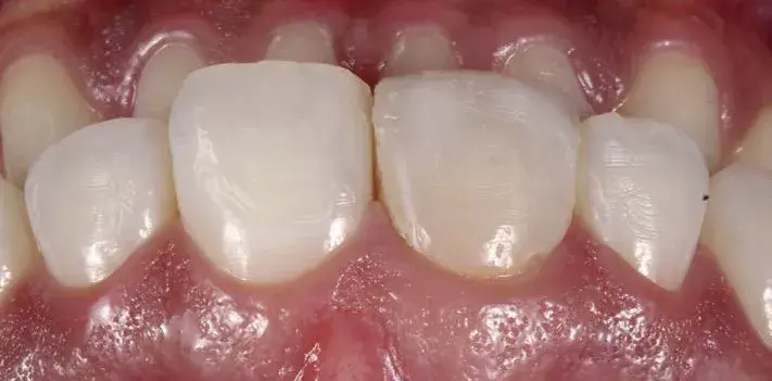 Tooth discoloration