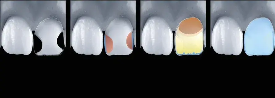 Veneer with Class III restorations