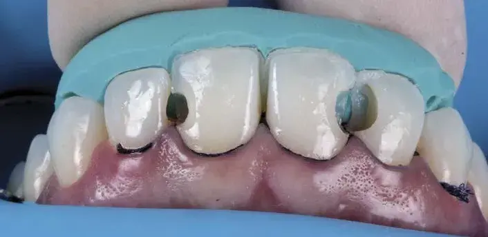 Palatal enamel