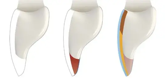 Veneer preparation with Class IV restorations