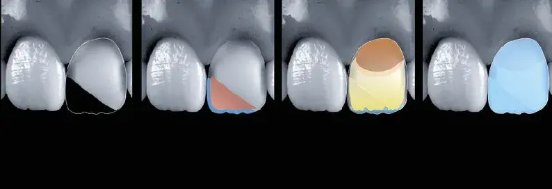 Veneer preparation with Class IV restorations