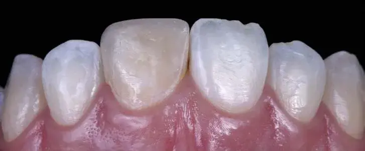 Darkened tooth with an unesthetic restoration