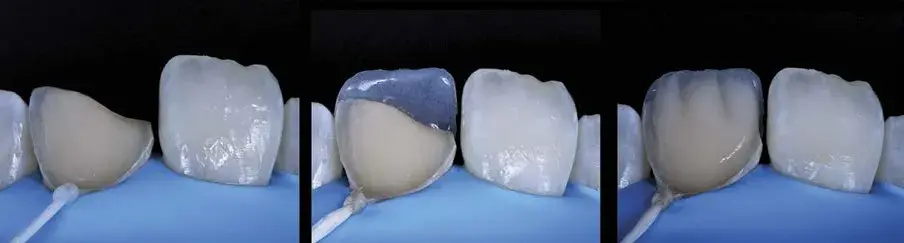 Palatal enamel and a resin for the dentin